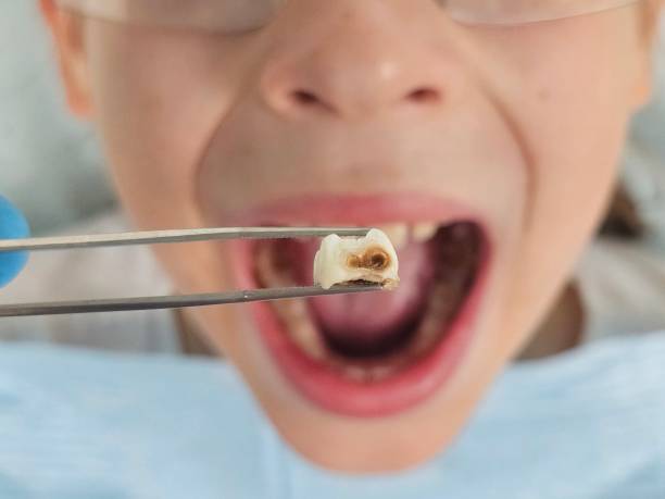 Best Cracked Tooth Emergency Dentist  in Hanover, OH